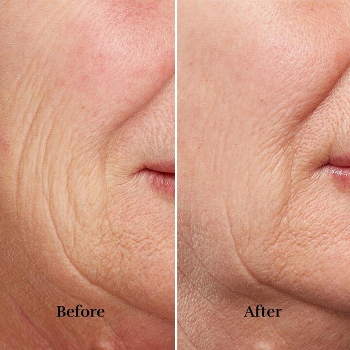 Silkn FaceTite Revive FTC1PE1001: reducción de arrugas y reafirmación de la piel